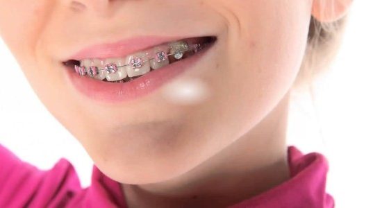 вирівнювання зубів у дітей